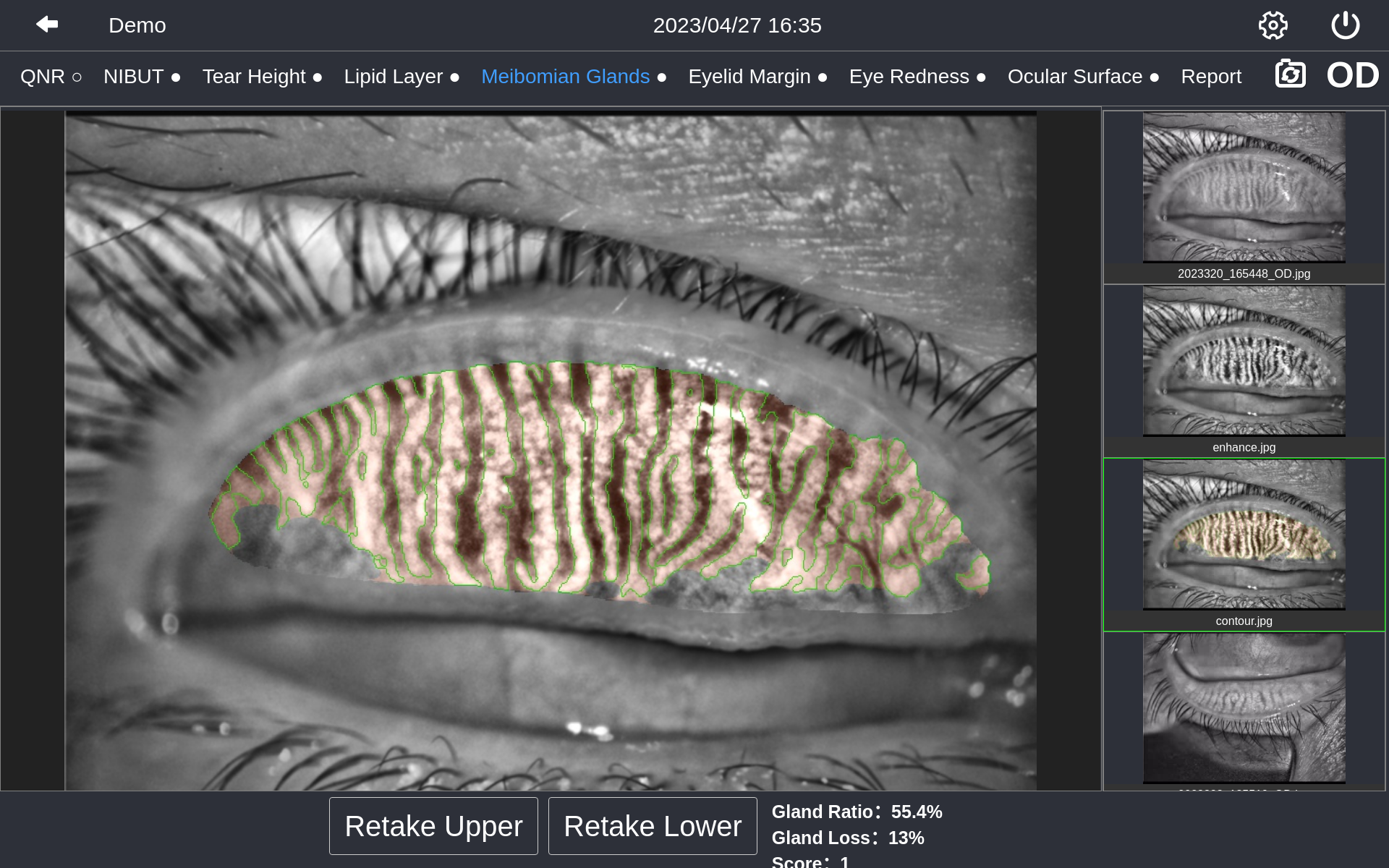 Upper Meibomian Glands-contour.png