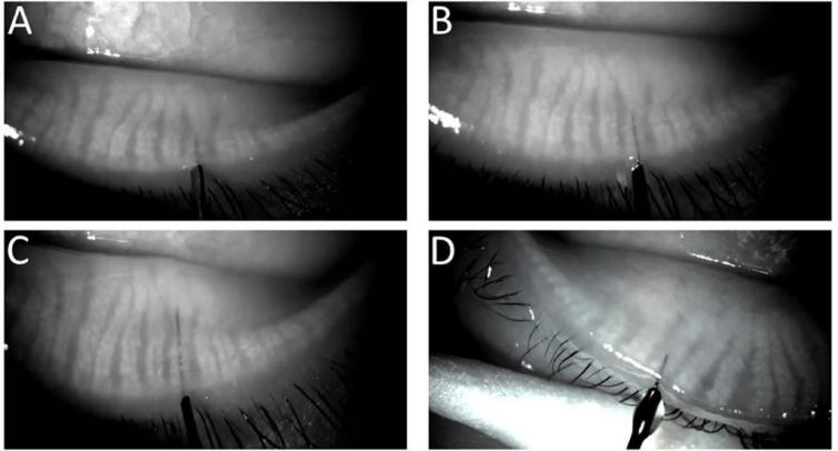 Meibography guided intraductal meibomian gland probing using real-time infrared video feed