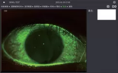 Corneal Fluorescein Staining