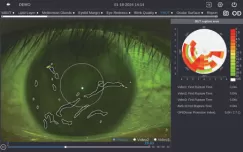 Fluorescein Tear Film Breakup Time