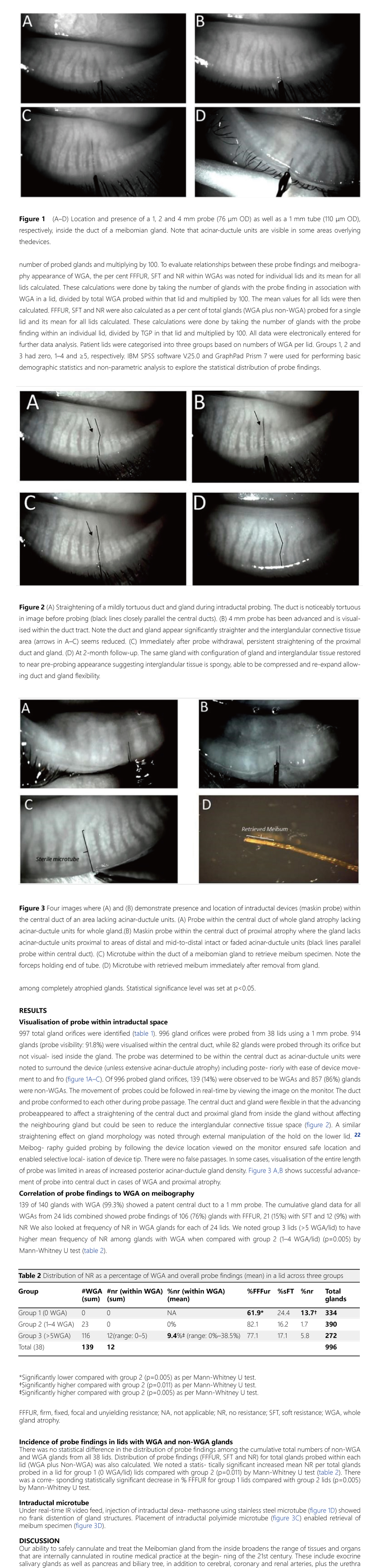 Meibography guided intraductal meibomian gland probing using real-time infrared video feed