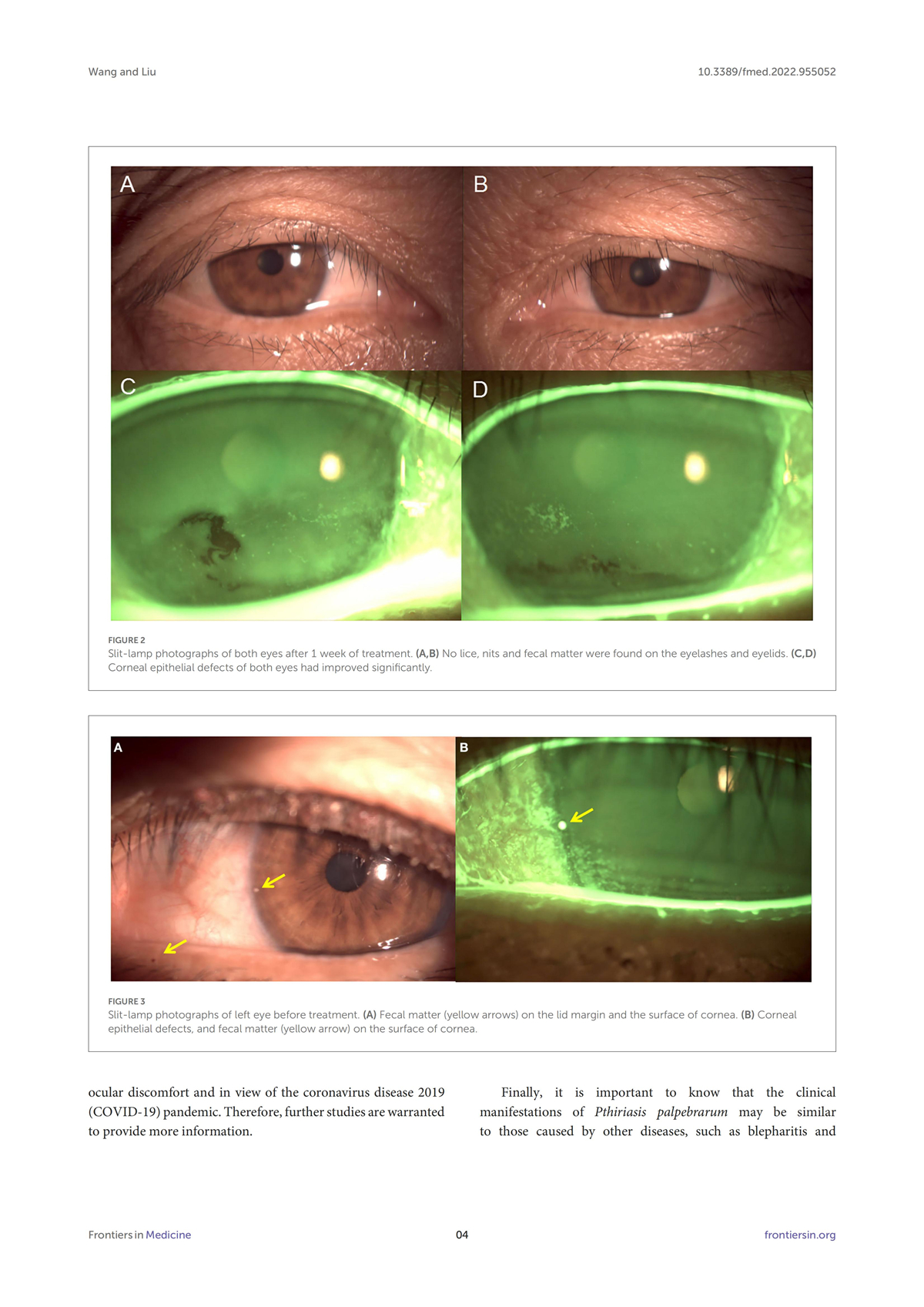 Case report: A case of corneal epithelial injury associated with Pthiriasis palpebrarum