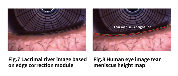 Tear meniscus height detection based on deep learning