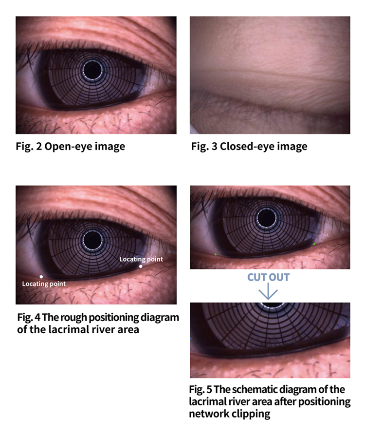 Tear meniscus height detection based on deep learning
