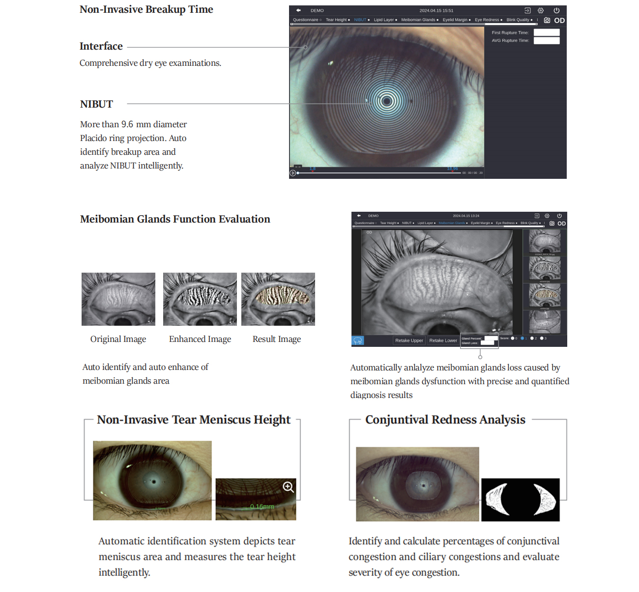 Dry Eye Analysis
