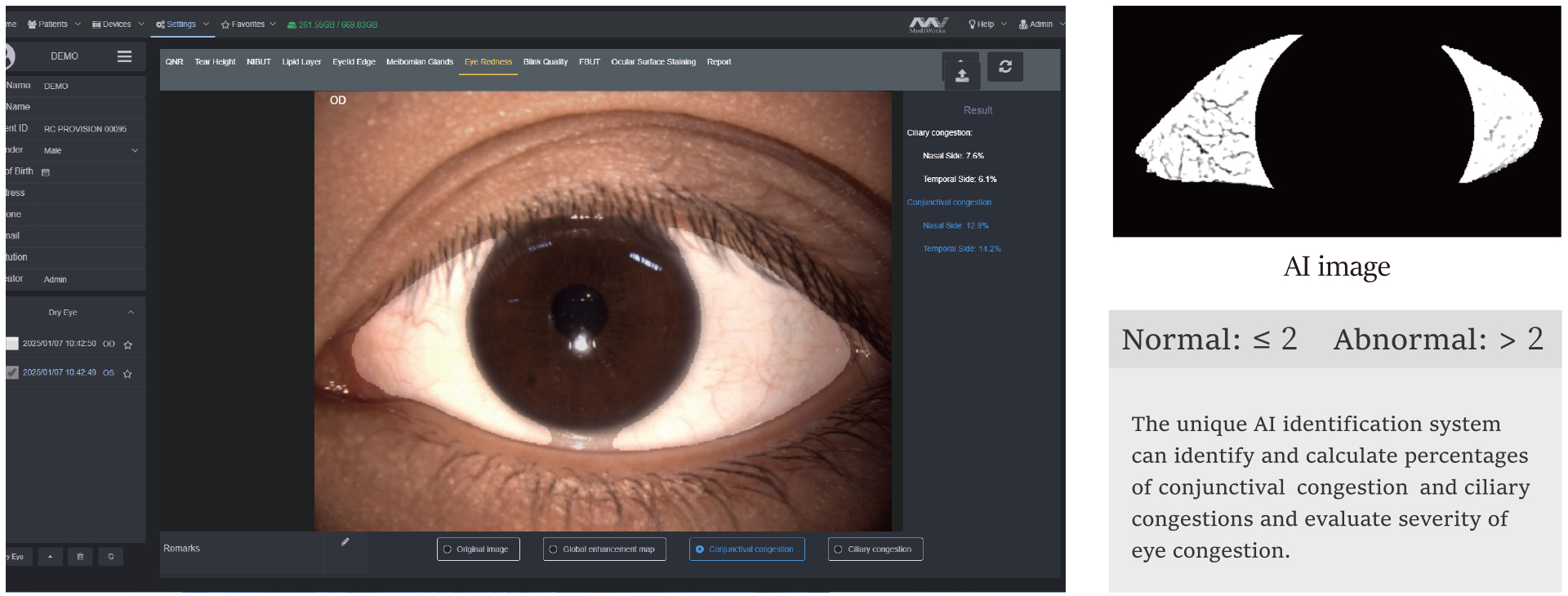 Analysis of Conjunctival Hyperemia