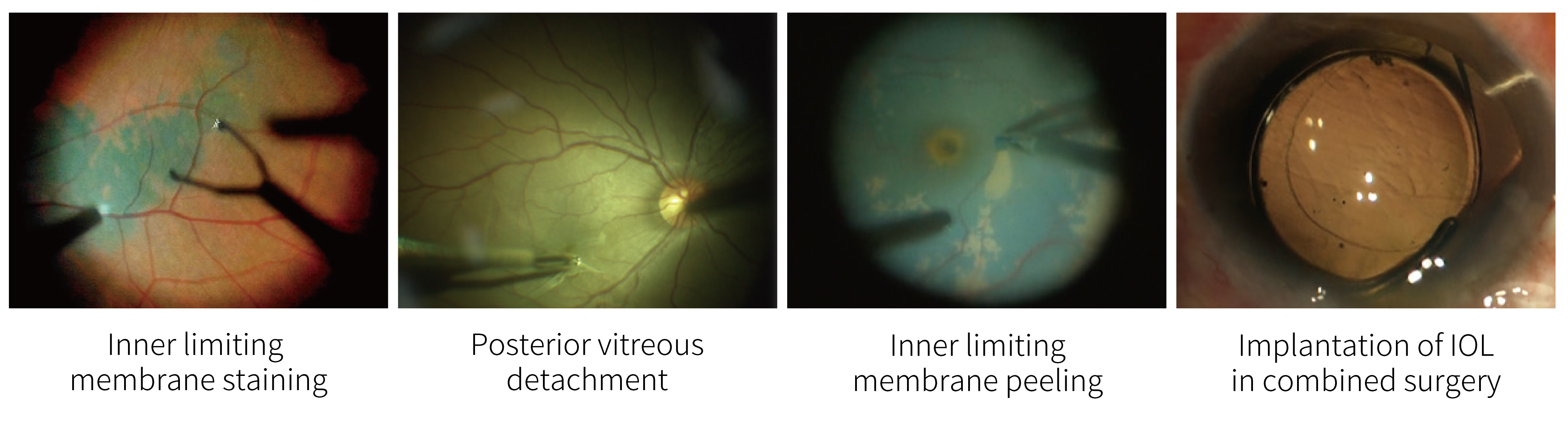 SM621 Ophthalmic Surgical Microscope