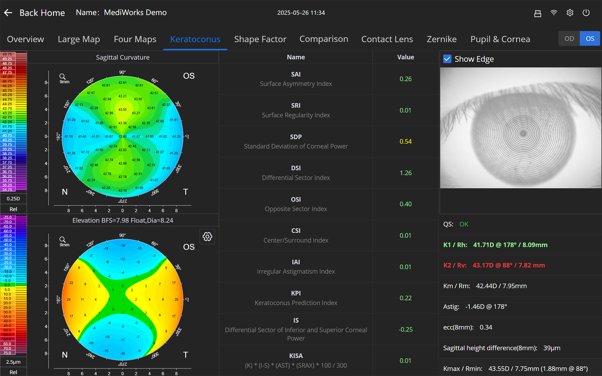 Keratoconus Screening