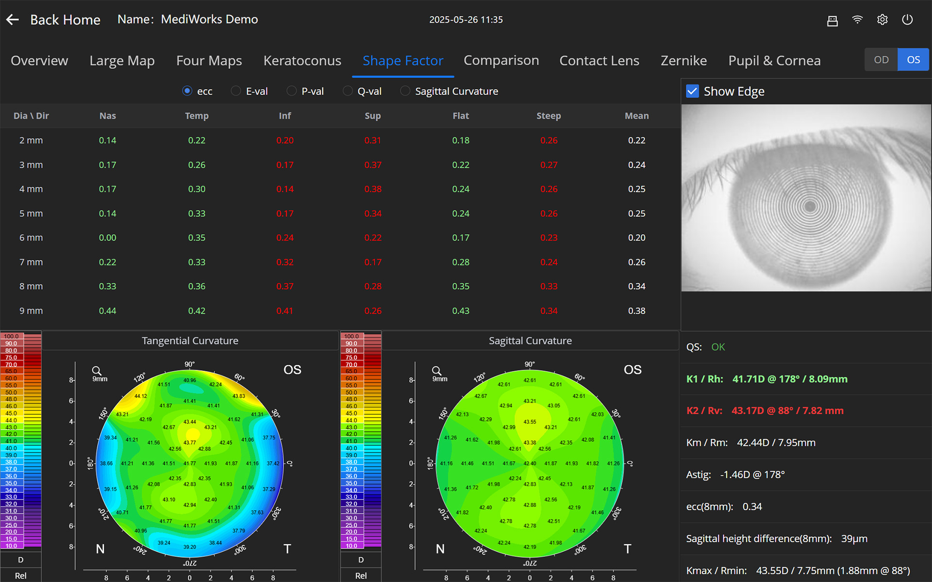 Orthokeratology Lens Fitting