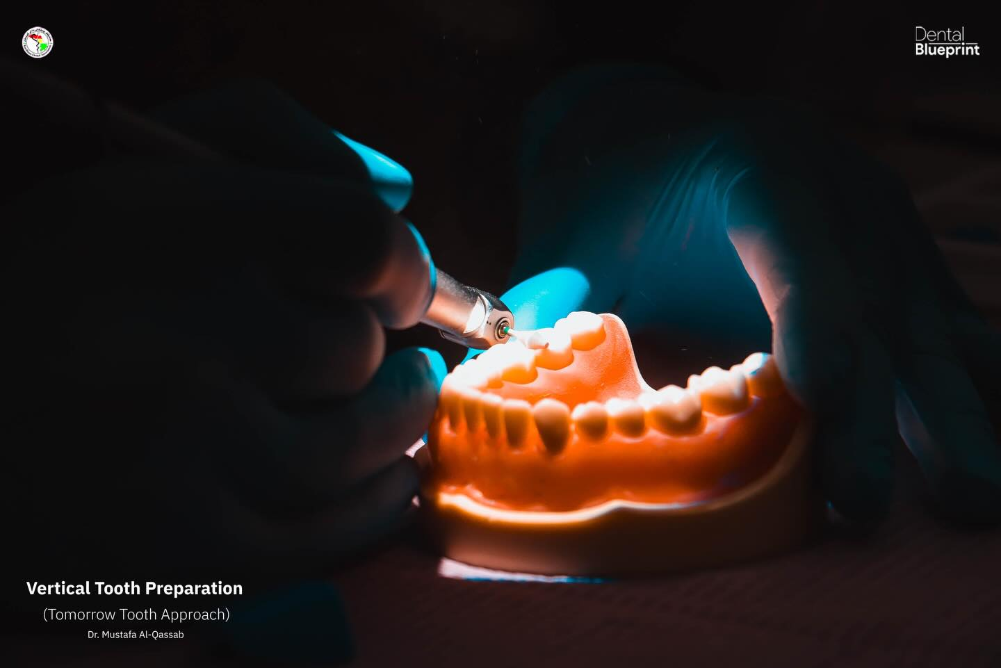 Dr. Mustafa Al-Qassab Hosts Vertical Tooth Preparation Masterclass in Iraq, Highlighting the Role of Dental Surgical Microscopes