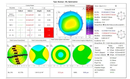 4 Steps of IOL Optimization