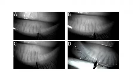 Meibography guided intraductal meibomian gland probing using real-time infrared video feed