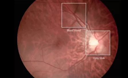 Mydriatic or Non Mydriatic Fundus Camera, Which Is Better?