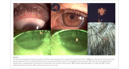 Case report: A case of corneal epithelial injury associated with Pthiriasis palpebrarum