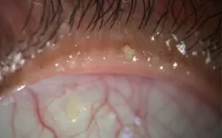 Eyelid Margin