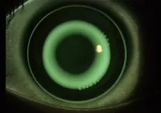 Orthokeratology Lens Fitting