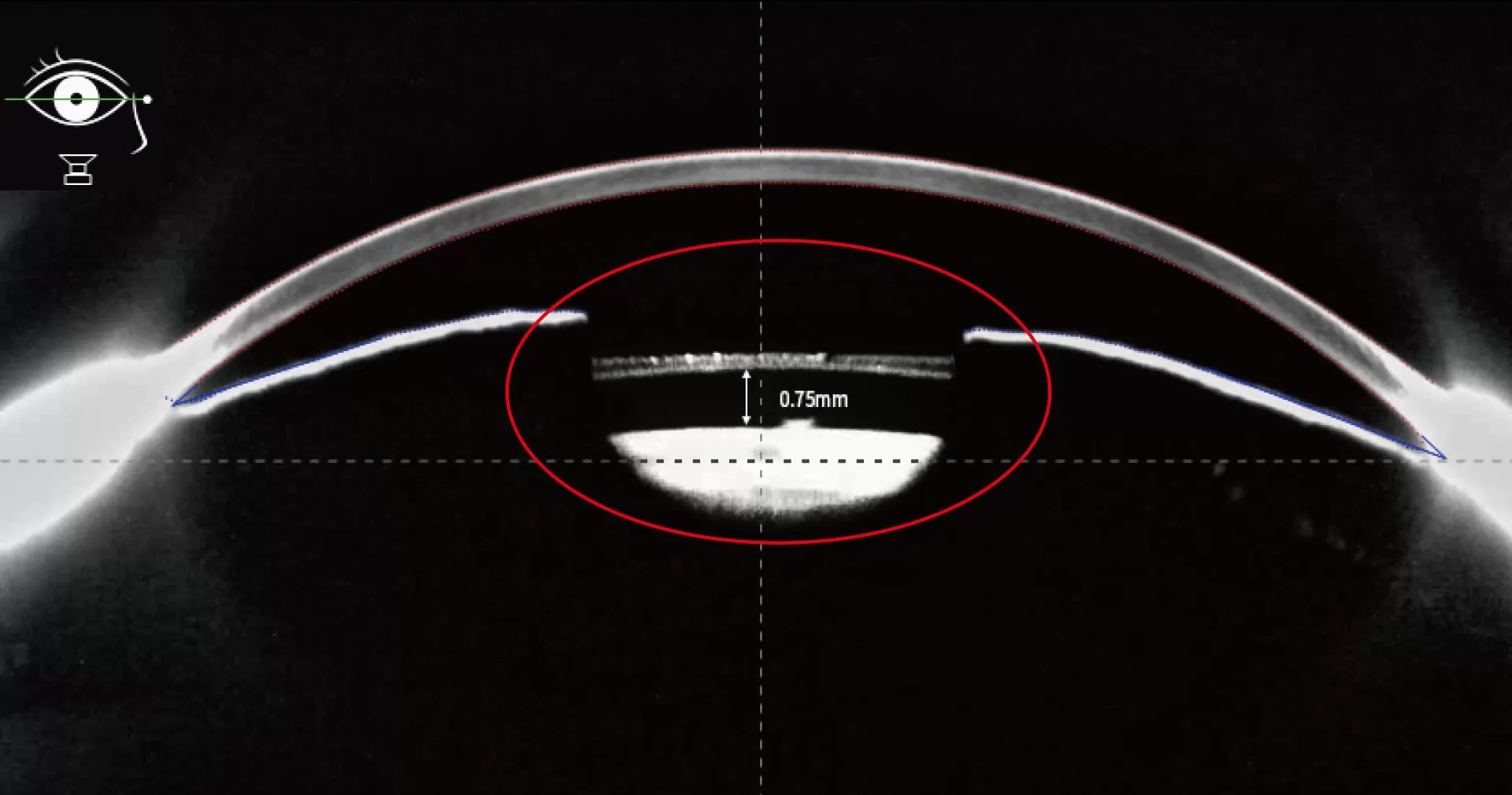 Postoperative ICL Vault Measurement