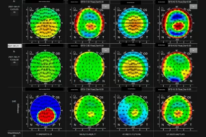 Bilateral Differential Topography - A Novel Topographic Algorithm for Keratoconus and Ectatic Disease Screening