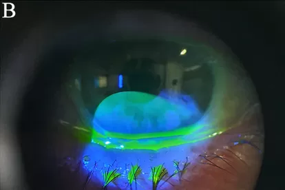 The Influence of Lid-Parallel Conjunctivaal Folds and Conjunctivochalasis on Dry Eye Symptoms with and Without Contact Lens Wear: A Review of the Literature