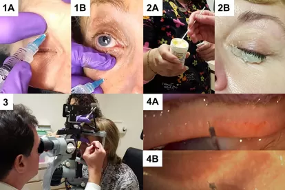 Review of Literature on Intraductal Meibomian Gland Probing with Insights from the Inventor and Developer: Fundamental Concepts and Misconceptions