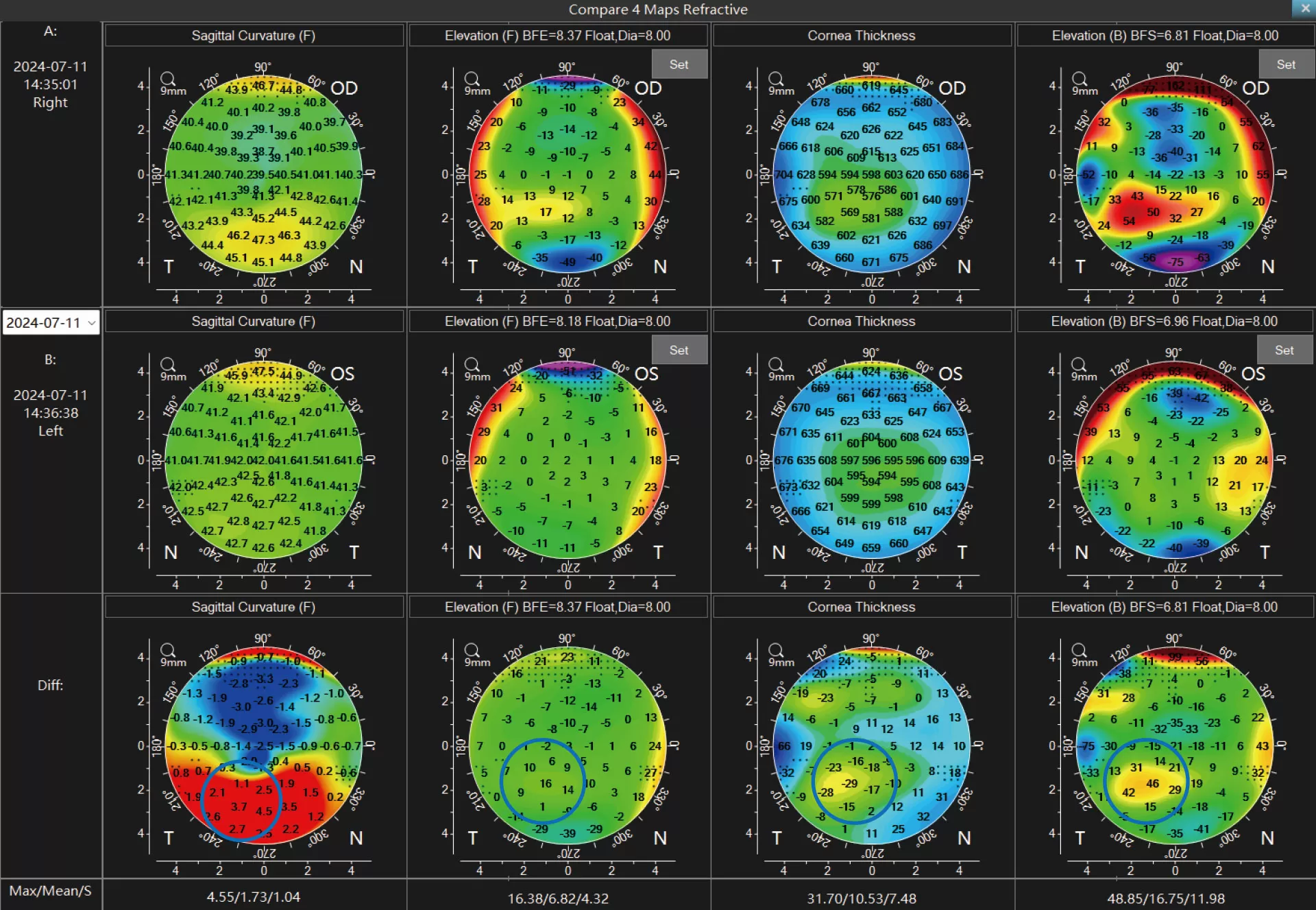 Binocular Contrast of Refractive 4 Maps