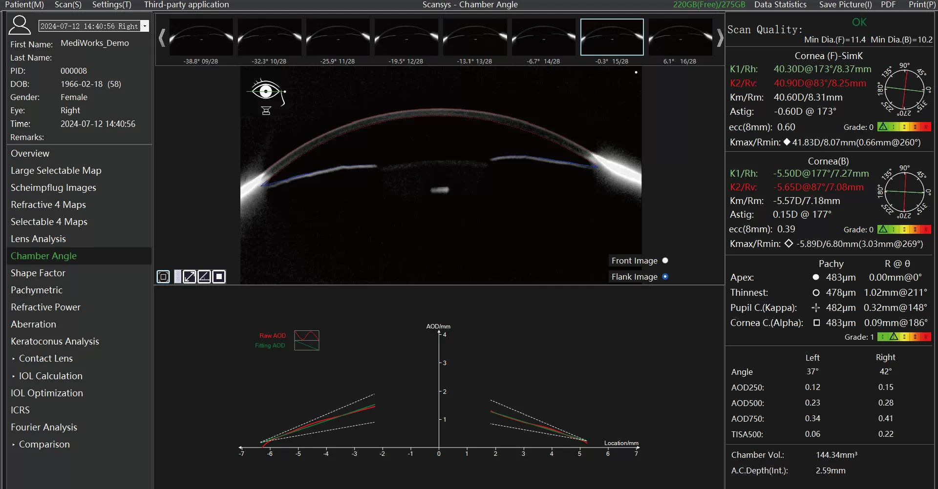 Anterior Chamber Angle Analysis